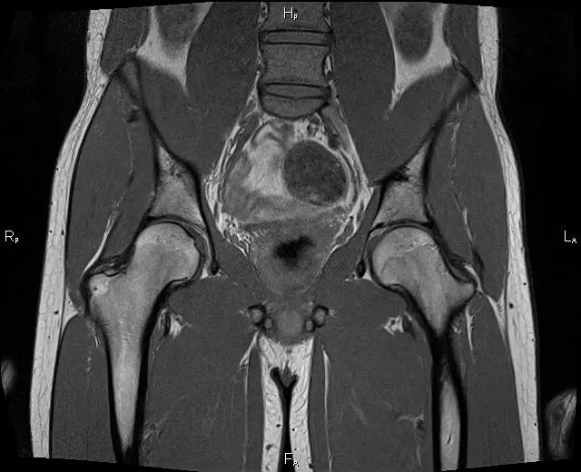 МРТ кульшового суглоба