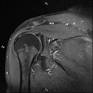 МРТ плечового суглоба