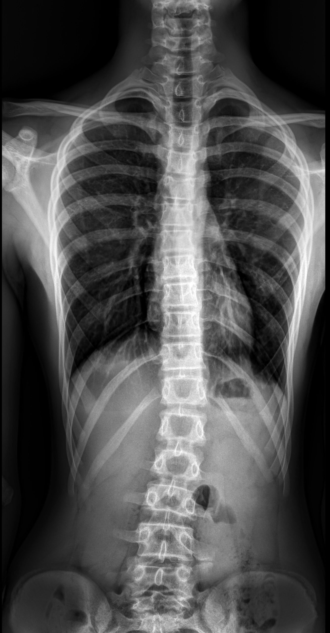 Рентгенография пояснично-крестцового отдела позвоночника