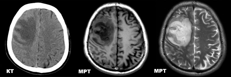 КТ и МРТ головного мозга